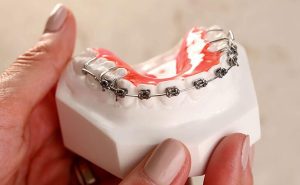 Fake Braces